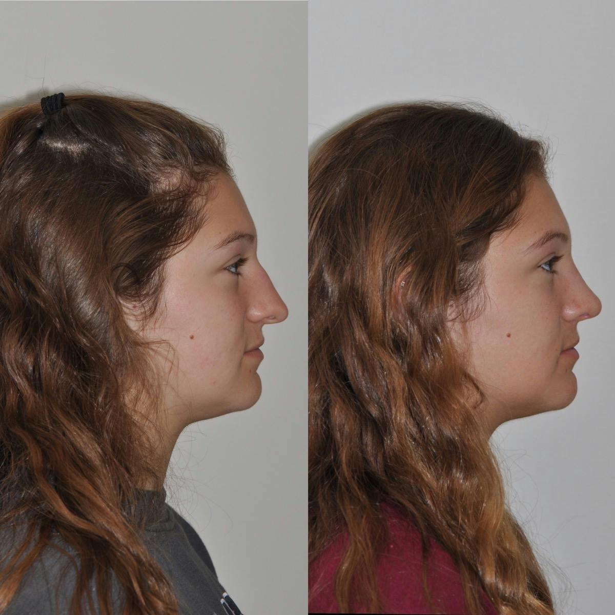 Rhinoplasty Before & After Gallery - Patient 203434 - Image 2
