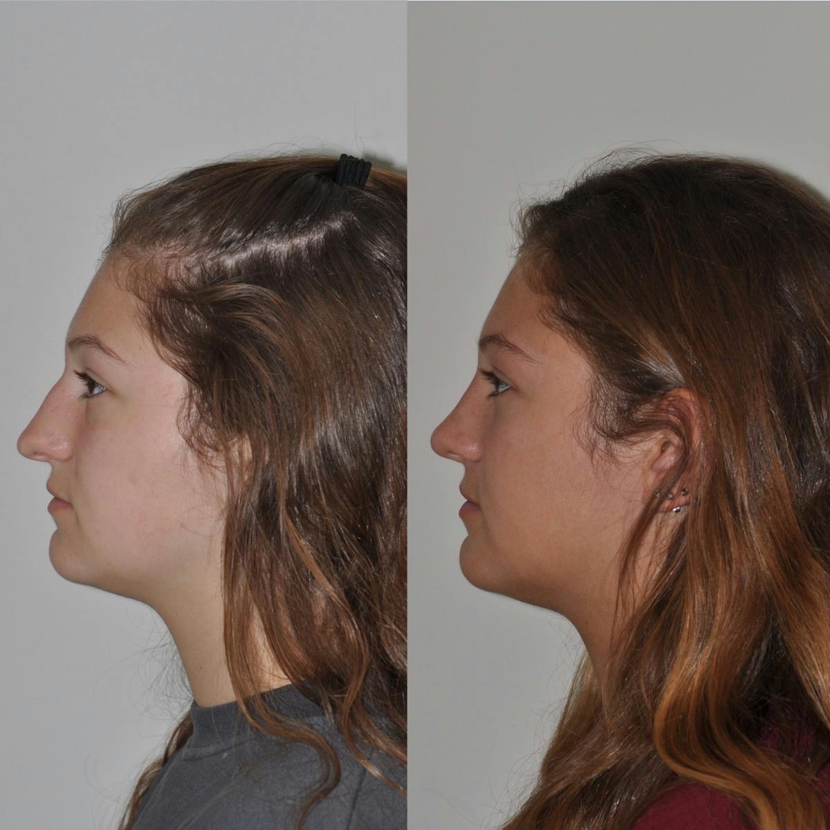 Rhinoplasty Before & After Gallery - Patient 203434 - Image 3