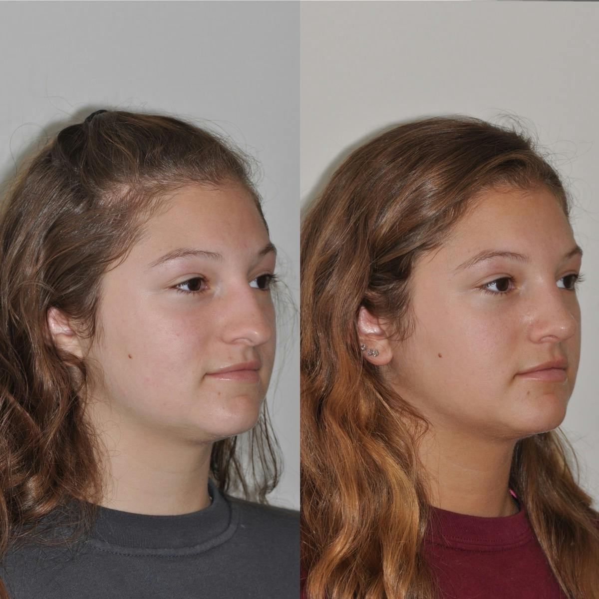 Rhinoplasty Before & After Gallery - Patient 203434 - Image 4