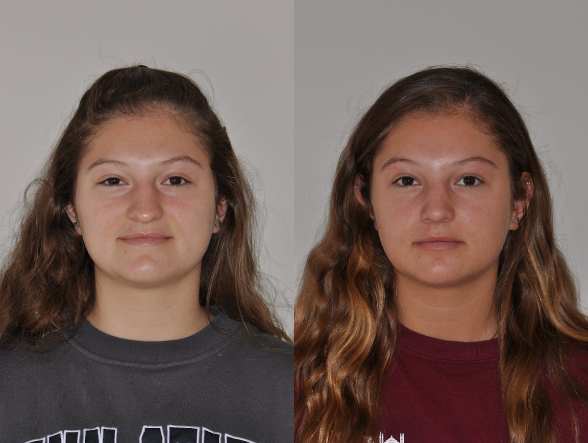 Rhinoplasty Before & After Gallery - Patient 203434 - Image 5