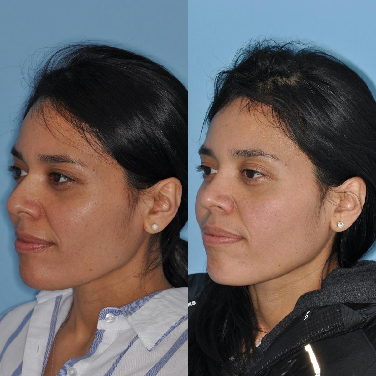Rhinoplasty Before & After Gallery - Patient 259043 - Image 1
