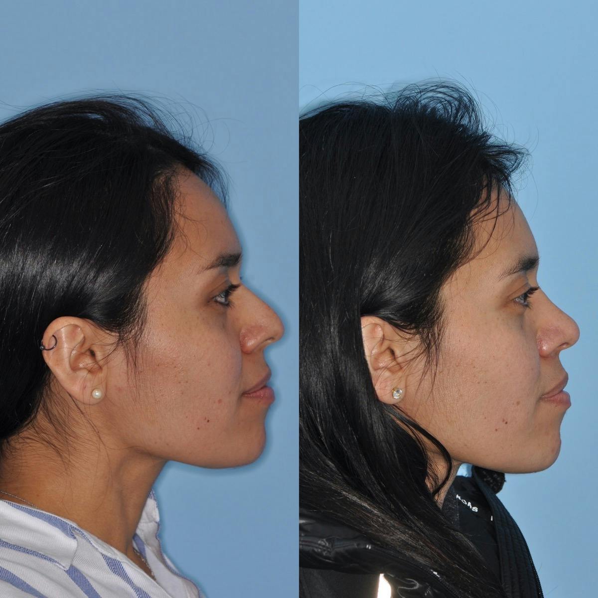 Rhinoplasty Before & After Gallery - Patient 259043 - Image 2
