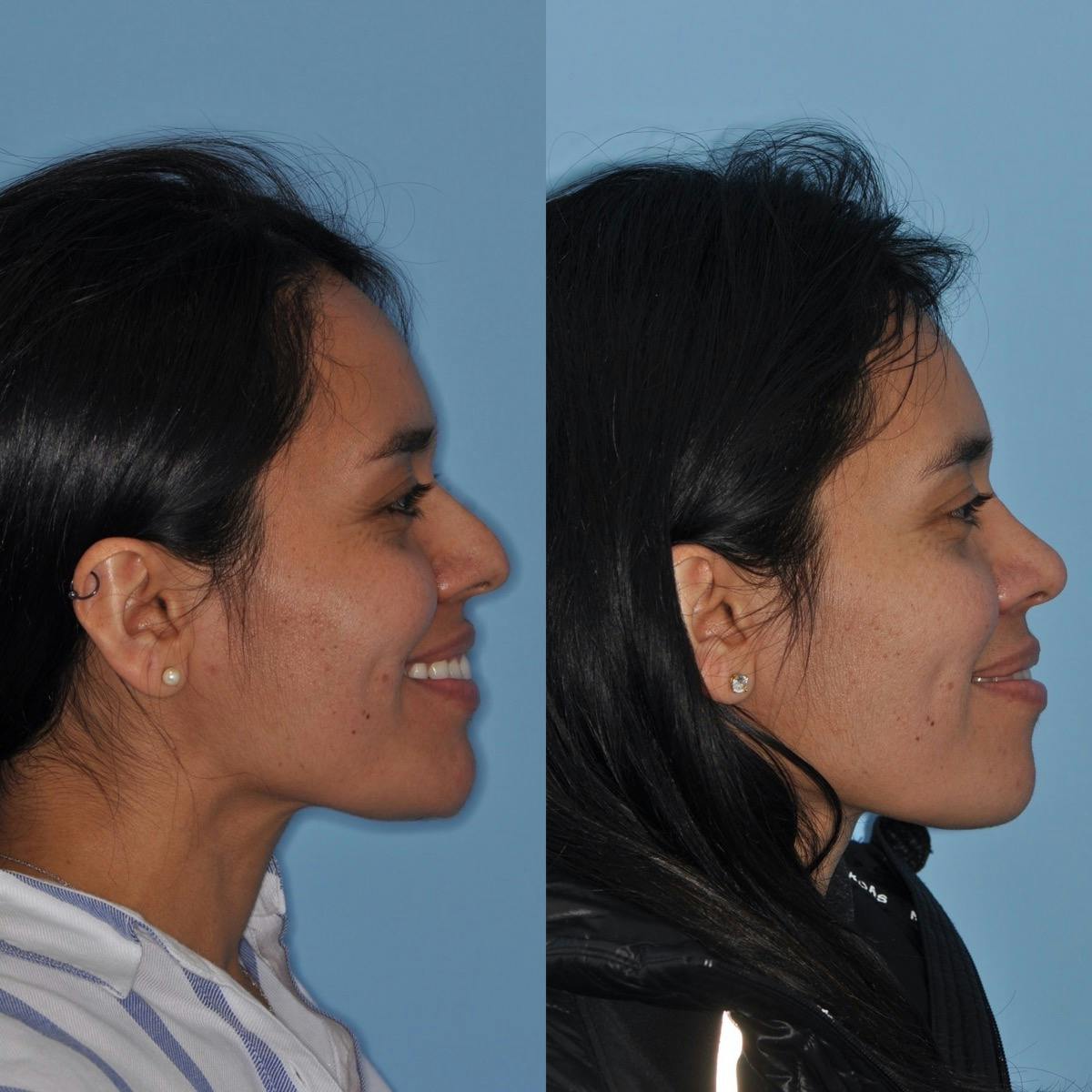 Rhinoplasty Before & After Gallery - Patient 259043 - Image 3