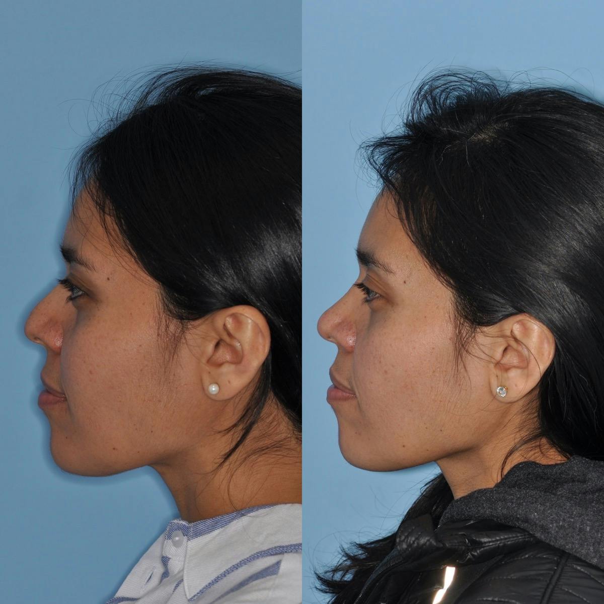 Rhinoplasty Before & After Gallery - Patient 259043 - Image 4