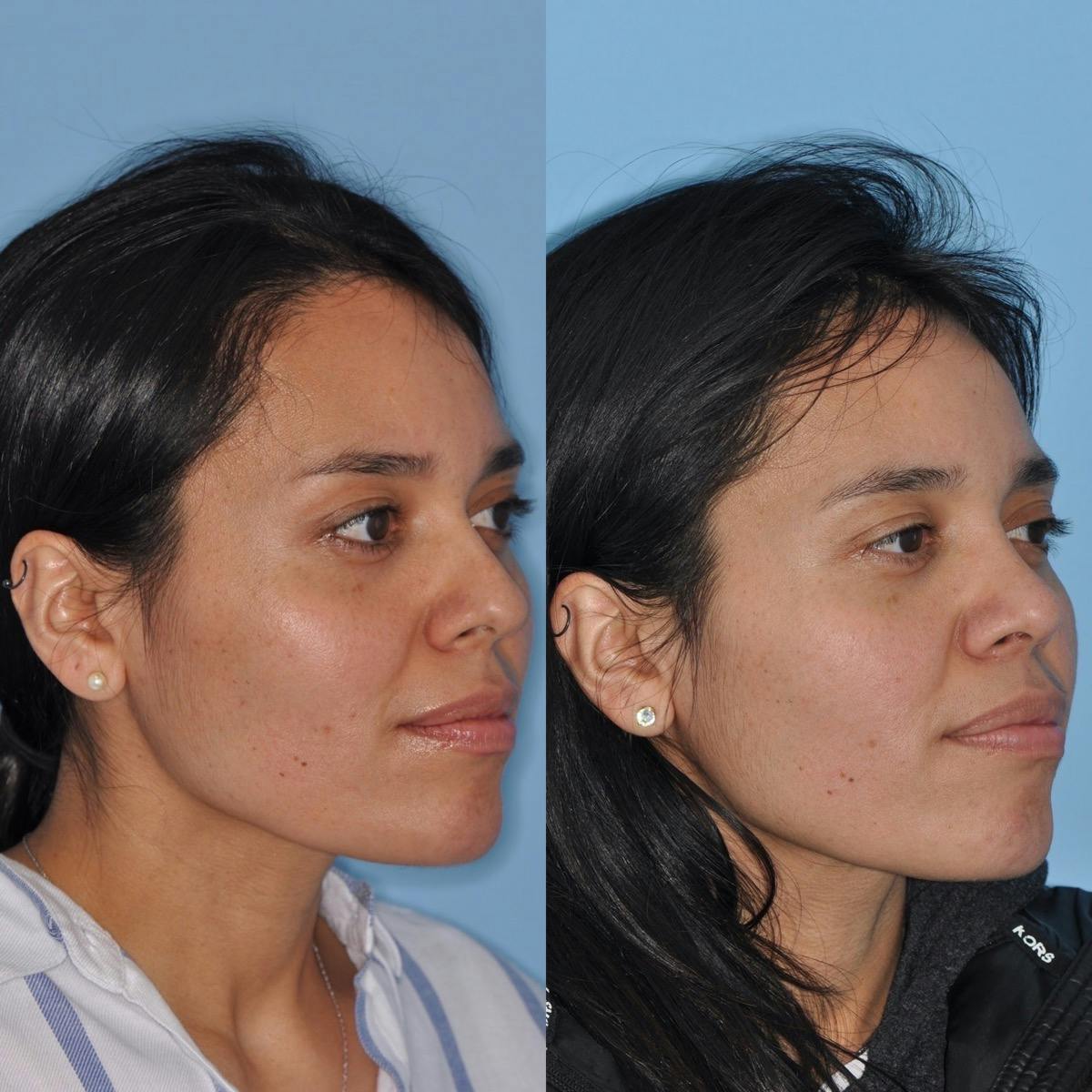 Rhinoplasty Before & After Gallery - Patient 259043 - Image 5