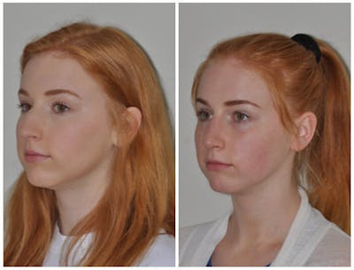 Rhinoplasty Before & After Gallery - Patient 133619 - Image 1