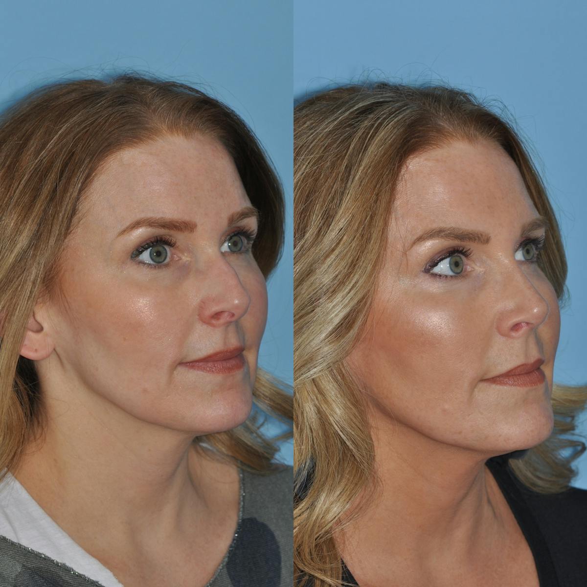 Rhinoplasty Before & After Gallery - Patient 382623 - Image 5
