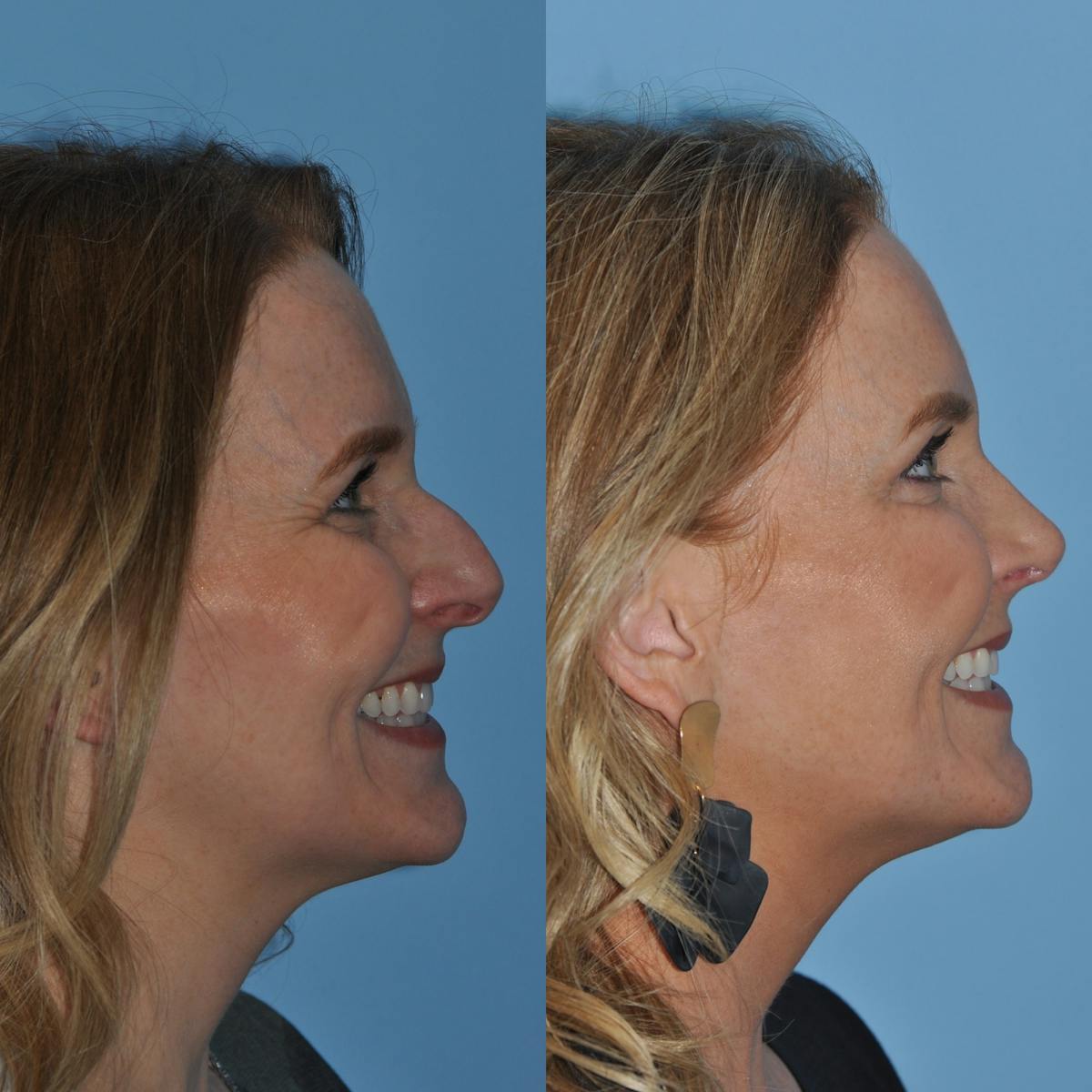 Rhinoplasty Before & After Gallery - Patient 382623 - Image 7