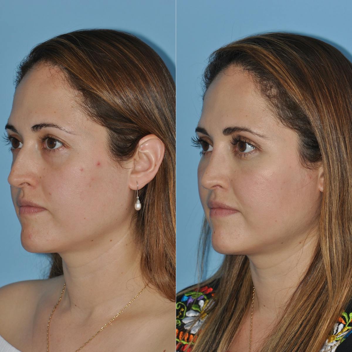Rhinoplasty Before & After Gallery - Patient 382045 - Image 1