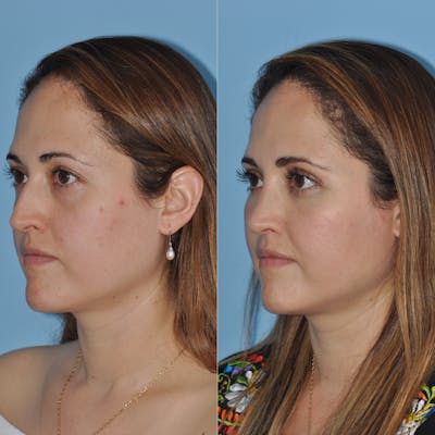 Rhinoplasty Before & After Gallery - Patient 382045 - Image 1