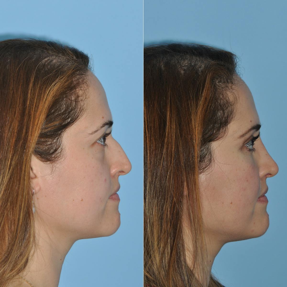 Rhinoplasty Before & After Gallery - Patient 382045 - Image 5