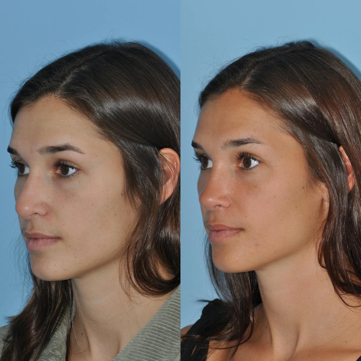 Rhinoplasty Before & After Gallery - Patient 643050 - Image 1
