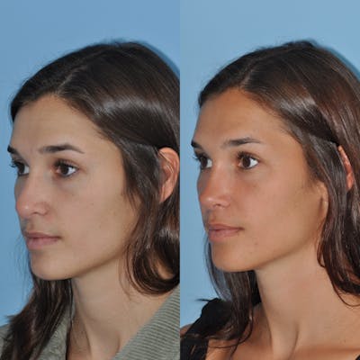Rhinoplasty Before & After Gallery - Patient 643050 - Image 1