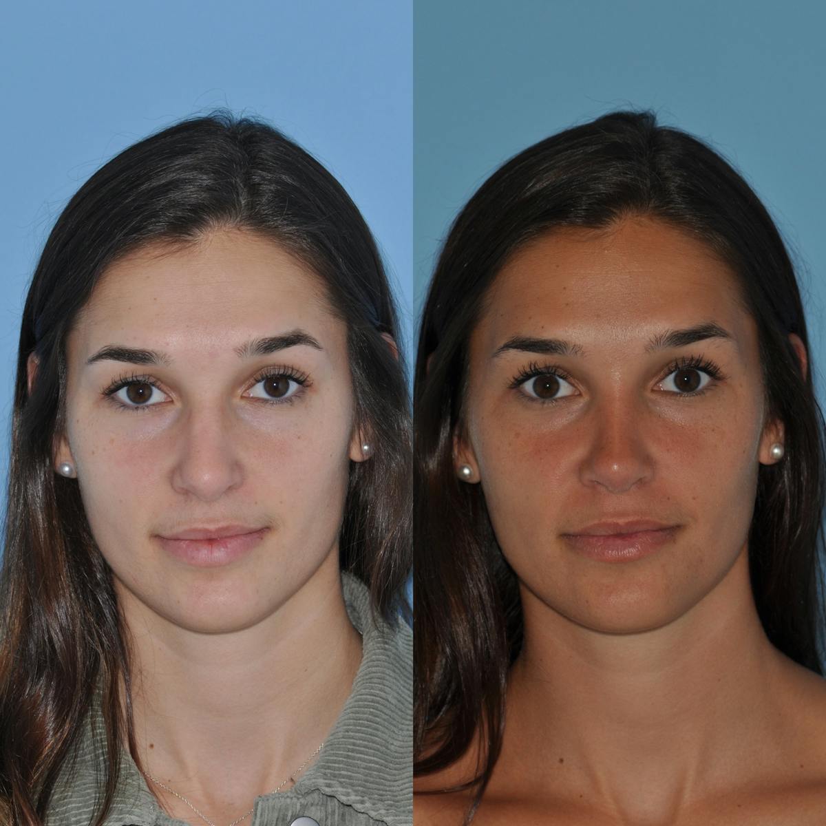 Rhinoplasty Before & After Gallery - Patient 643050 - Image 2