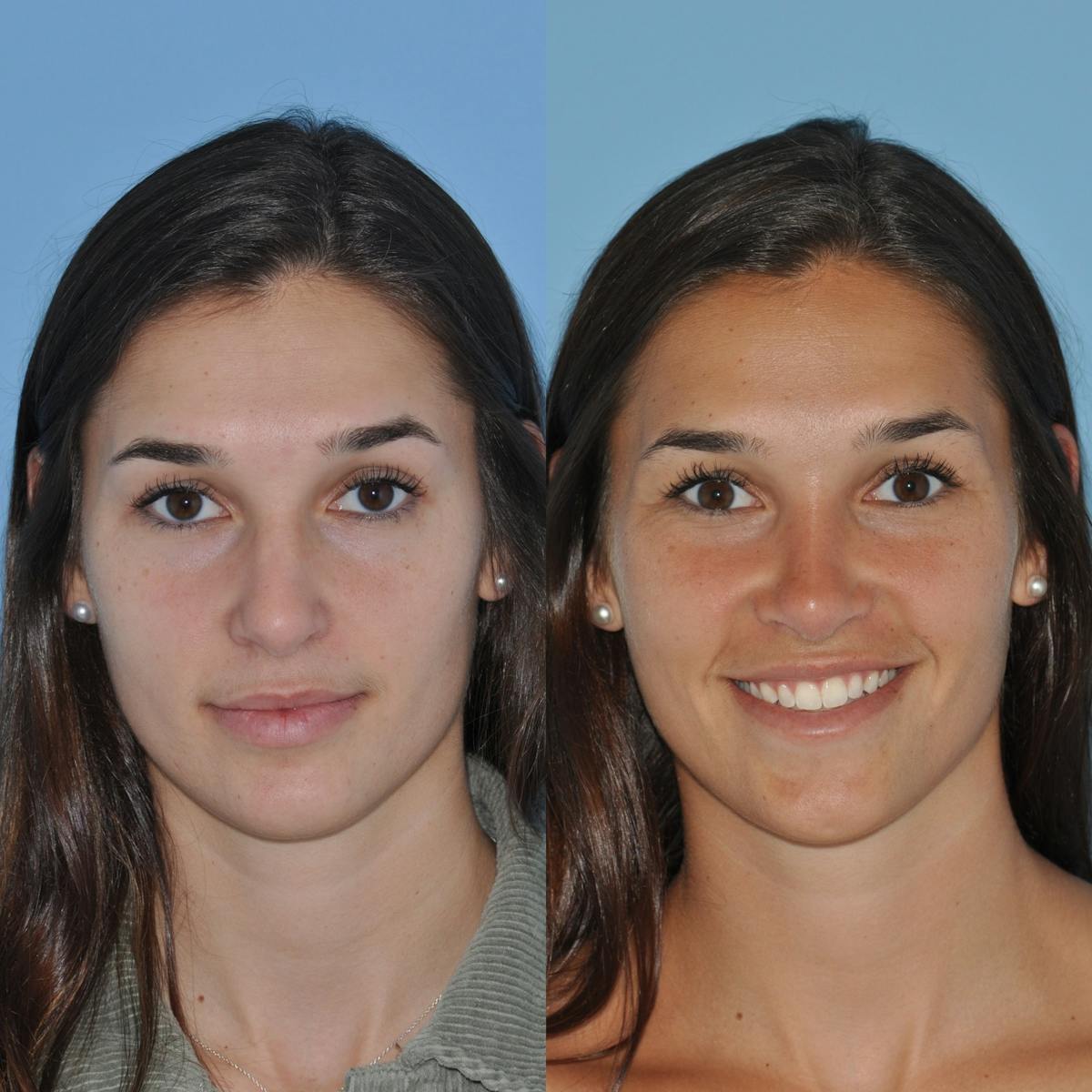 Rhinoplasty Before & After Gallery - Patient 643050 - Image 4