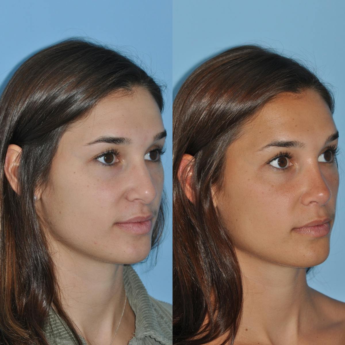 Rhinoplasty Before & After Gallery - Patient 643050 - Image 6