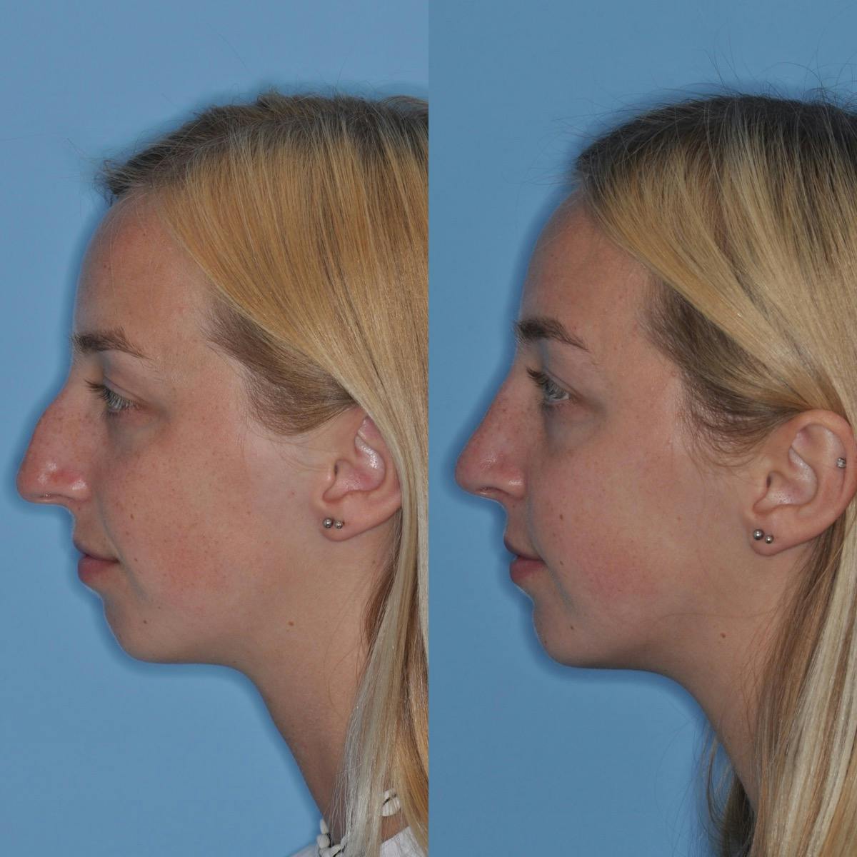 Rhinoplasty Before & After Gallery - Patient 411162 - Image 2