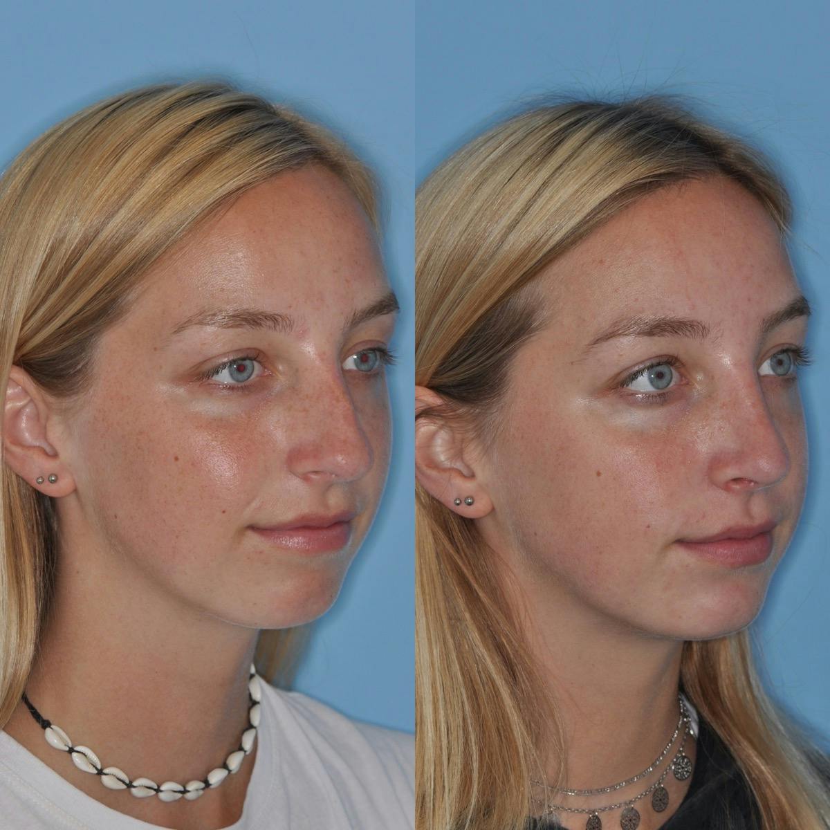 Rhinoplasty Before & After Gallery - Patient 411162 - Image 3