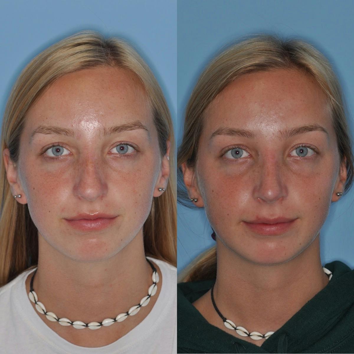 Rhinoplasty Before & After Gallery - Patient 411162 - Image 4