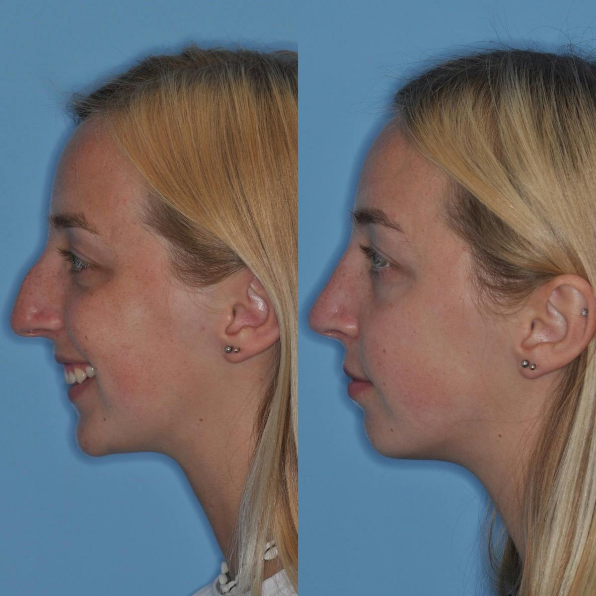 Rhinoplasty Before & After Gallery - Patient 411162 - Image 5