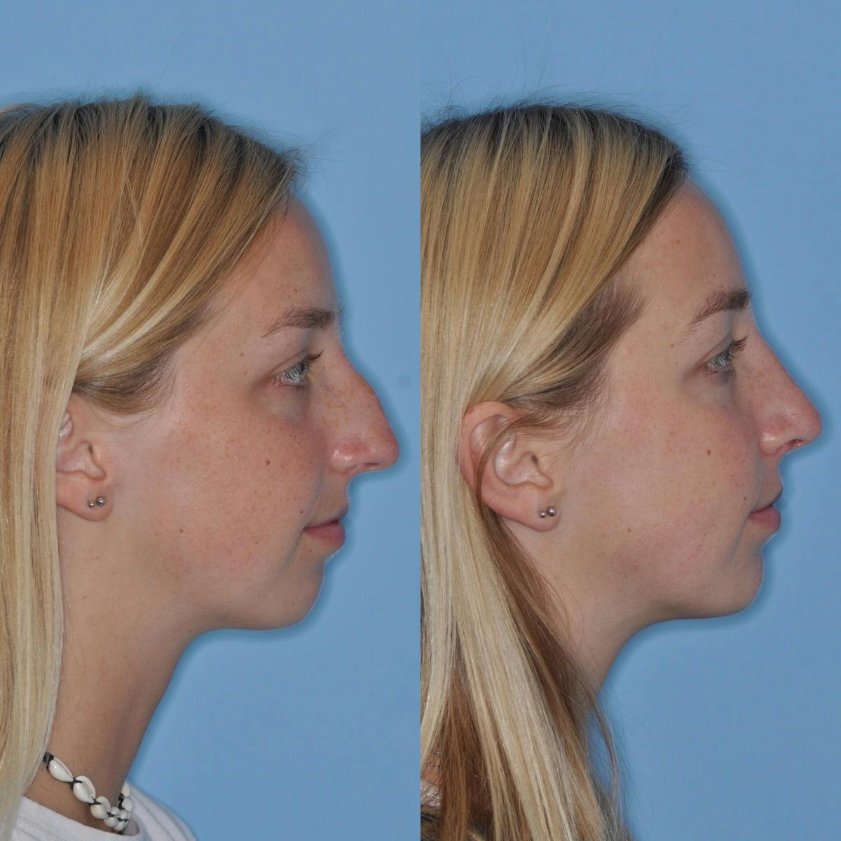 Rhinoplasty Before & After Gallery - Patient 411162 - Image 6