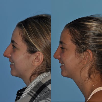 Rhinoplasty Before & After Gallery - Patient 258017 - Image 1