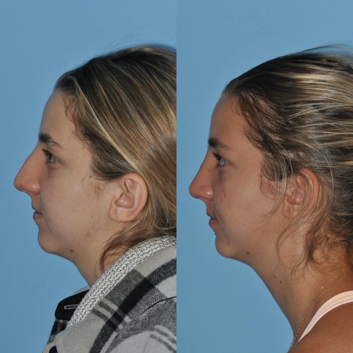 Rhinoplasty Before & After Gallery - Patient 258017 - Image 2