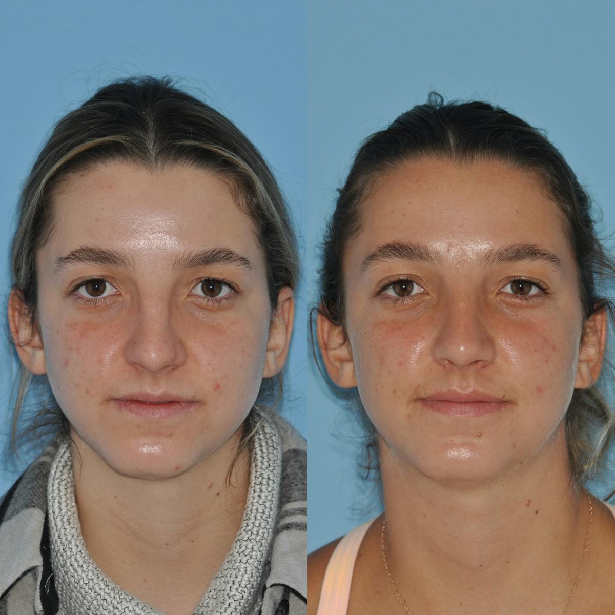 Rhinoplasty Before & After Gallery - Patient 258017 - Image 3