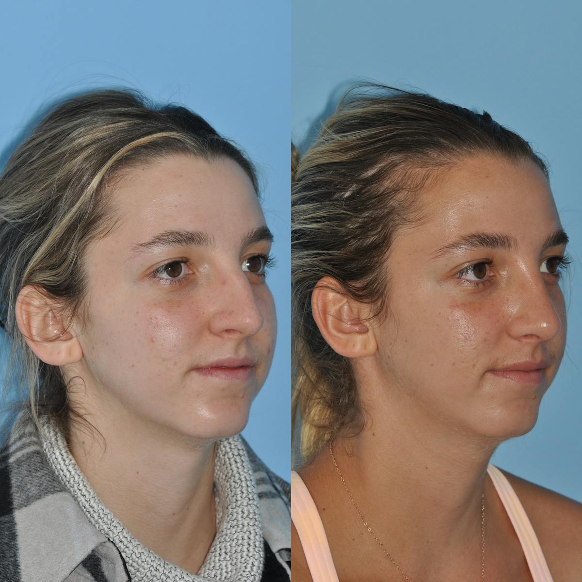 Rhinoplasty Before & After Gallery - Patient 258017 - Image 6