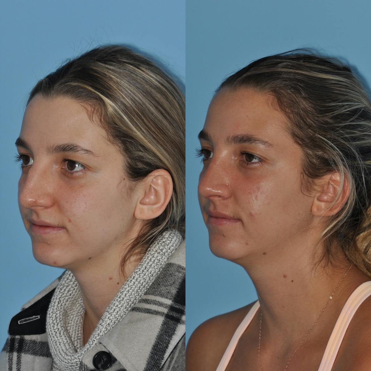 Rhinoplasty Before & After Gallery - Patient 258017 - Image 7