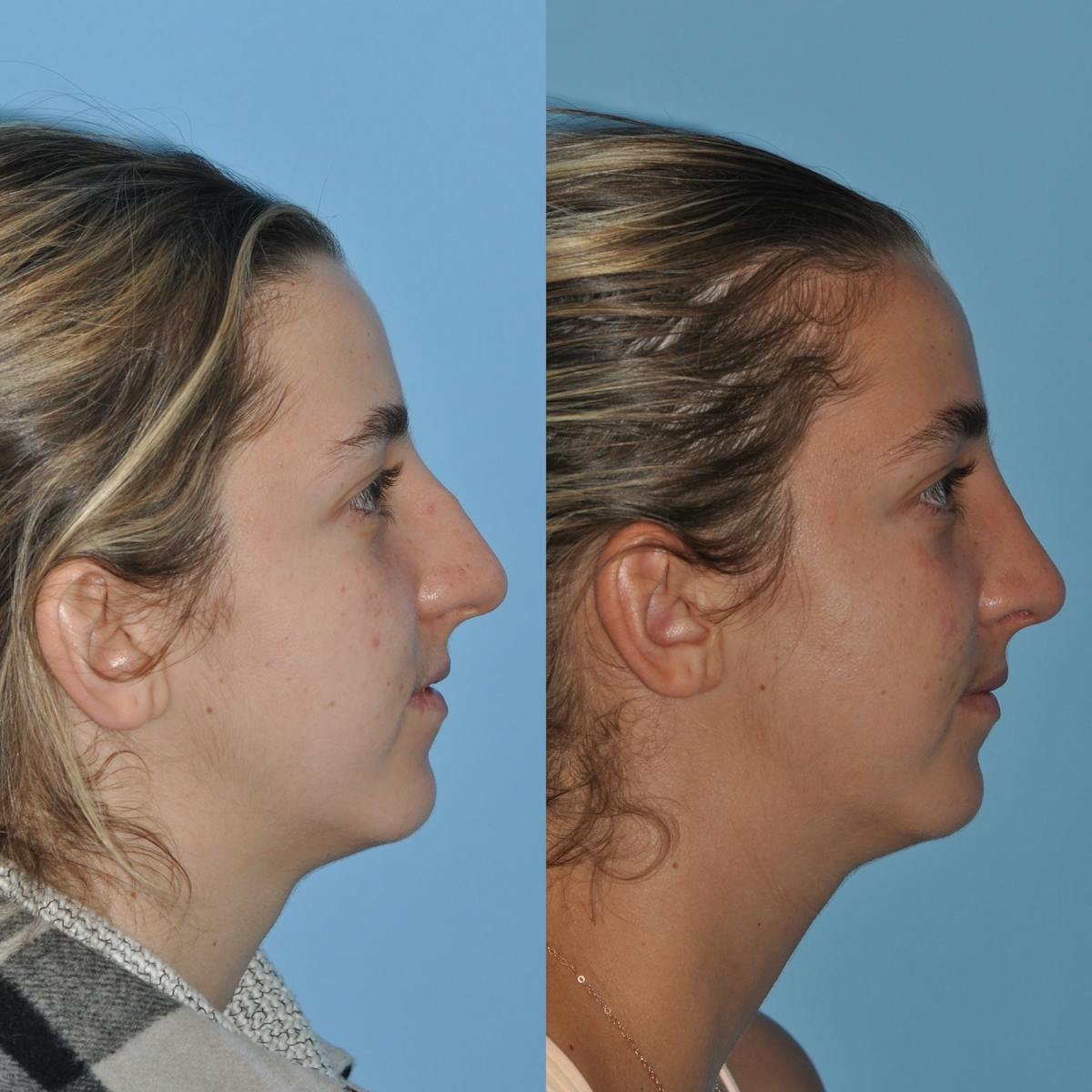 Rhinoplasty Before & After Gallery - Patient 258017 - Image 8