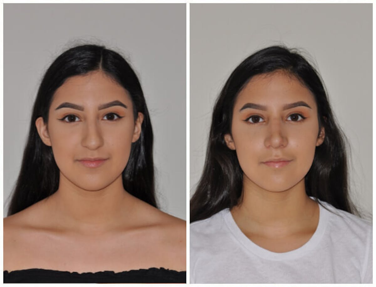Rhinoplasty Before & After Gallery - Patient 423120 - Image 2