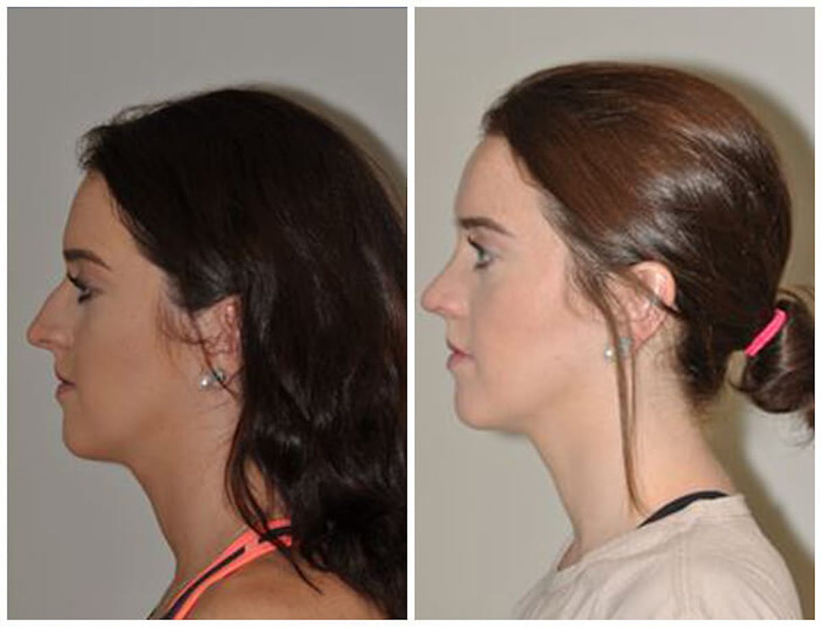 Rhinoplasty Before & After Gallery - Patient 246584 - Image 1