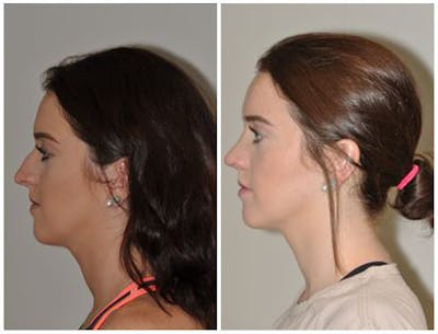 Rhinoplasty Before & After Gallery - Patient 246584 - Image 1