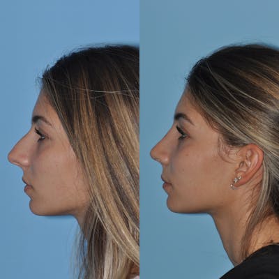 Rhinoplasty Before & After Gallery - Patient 166827 - Image 1