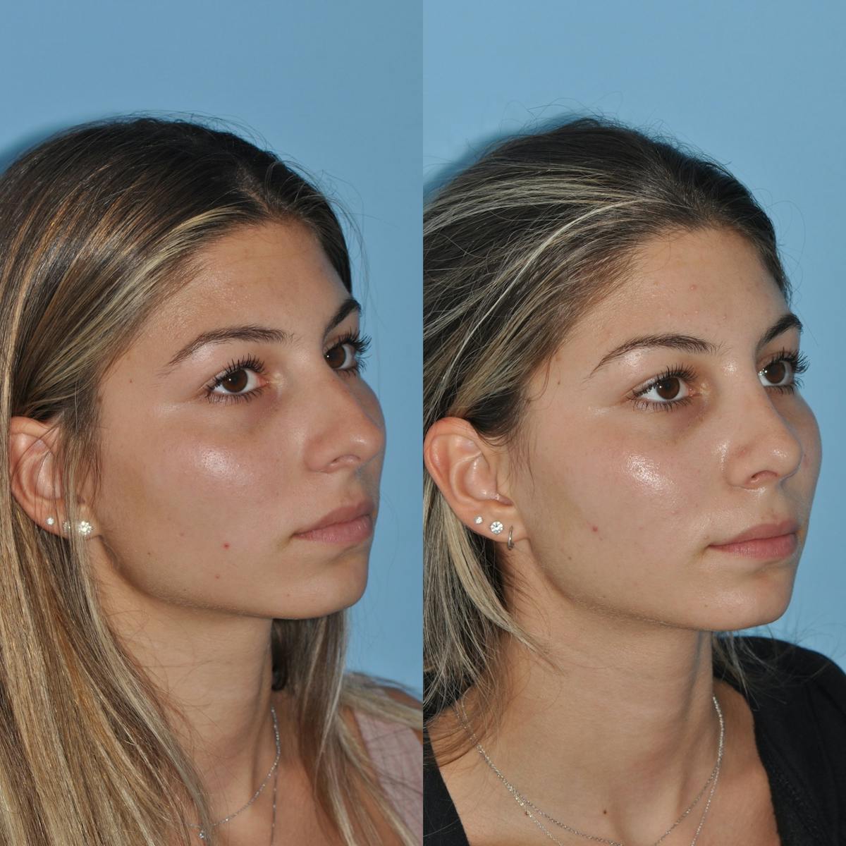 Rhinoplasty Before & After Gallery - Patient 194329 - Image 4