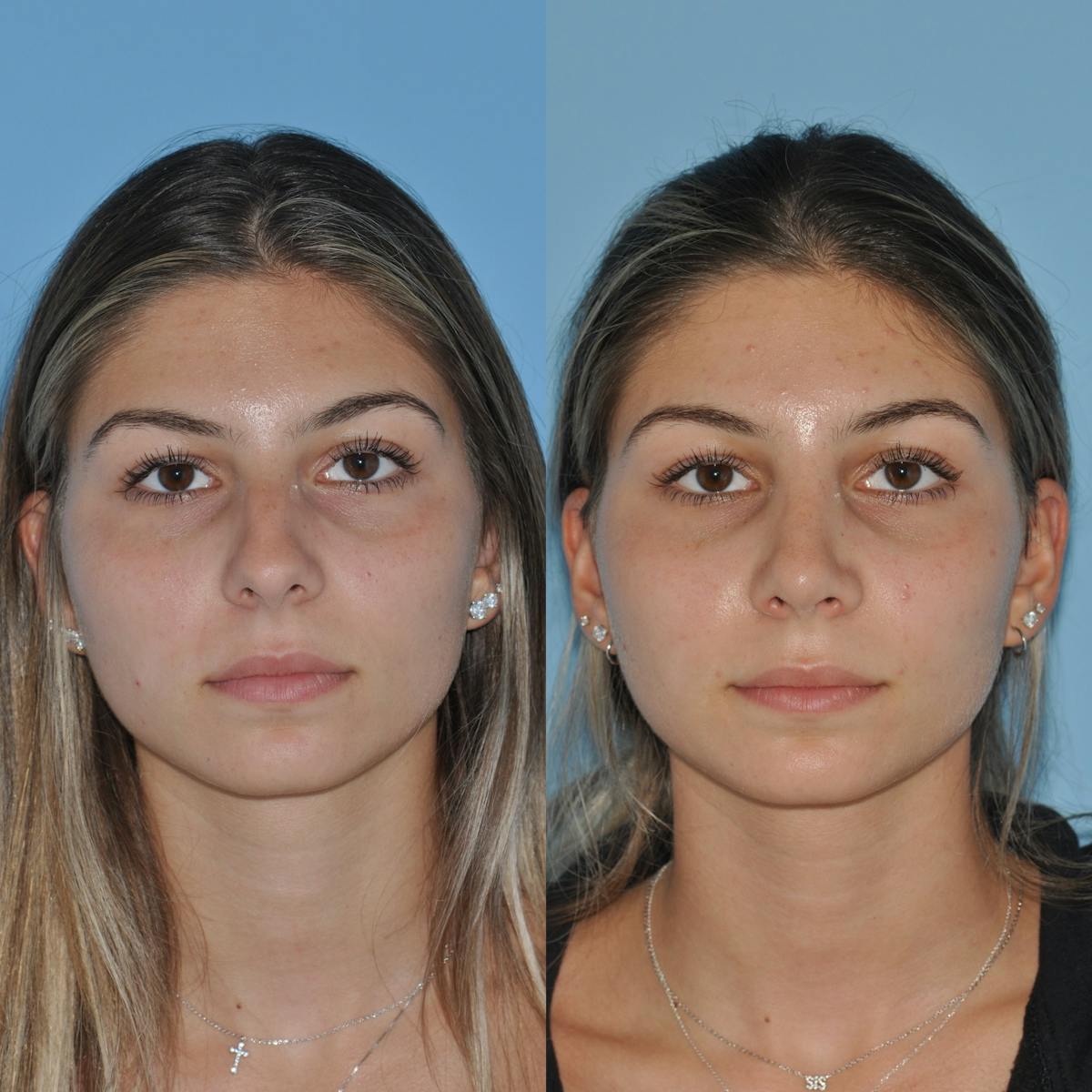 Rhinoplasty Before & After Gallery - Patient 194329 - Image 5