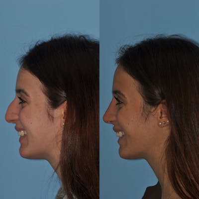 Rhinoplasty Before & After Gallery - Patient 219974 - Image 1
