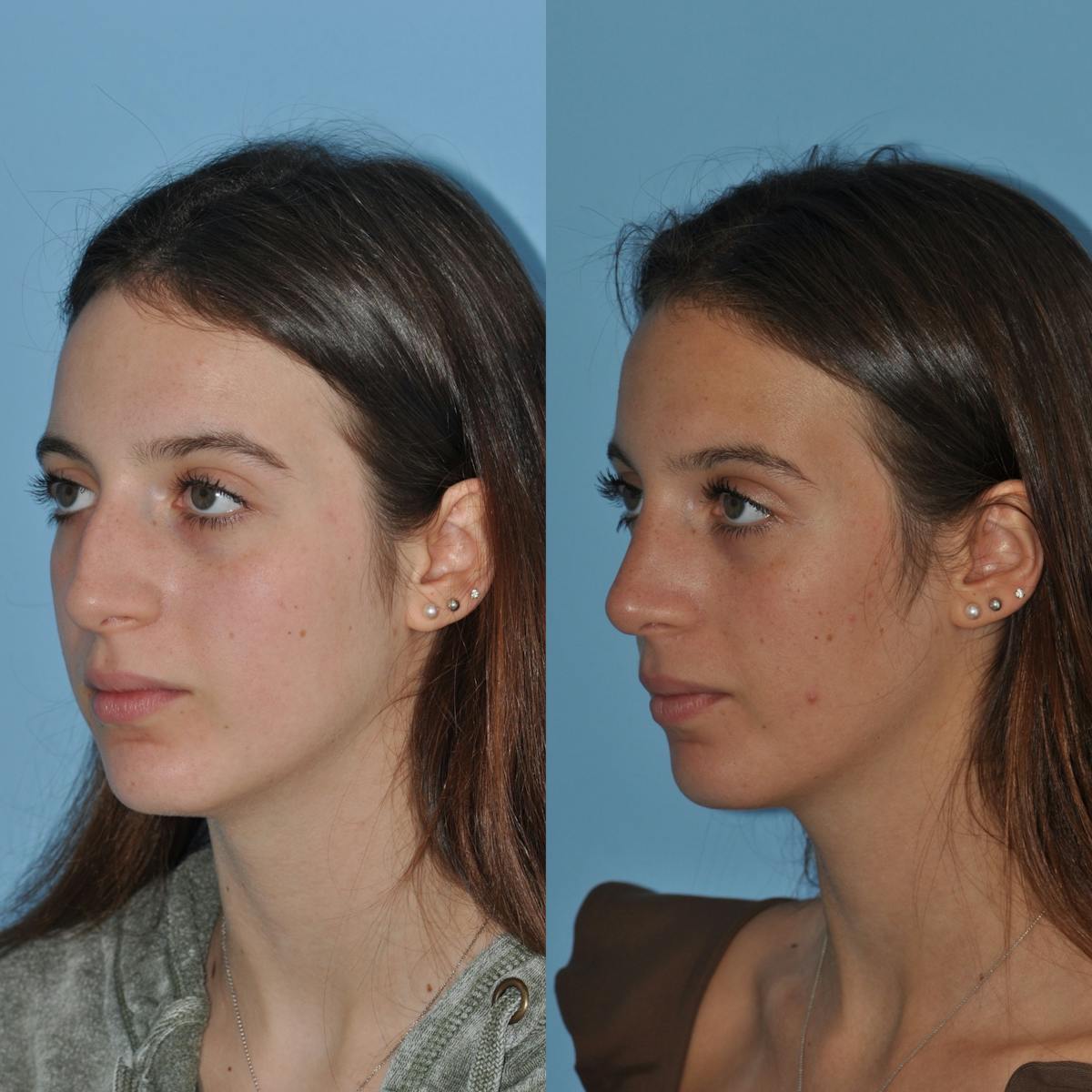 Rhinoplasty Before & After Gallery - Patient 219974 - Image 4