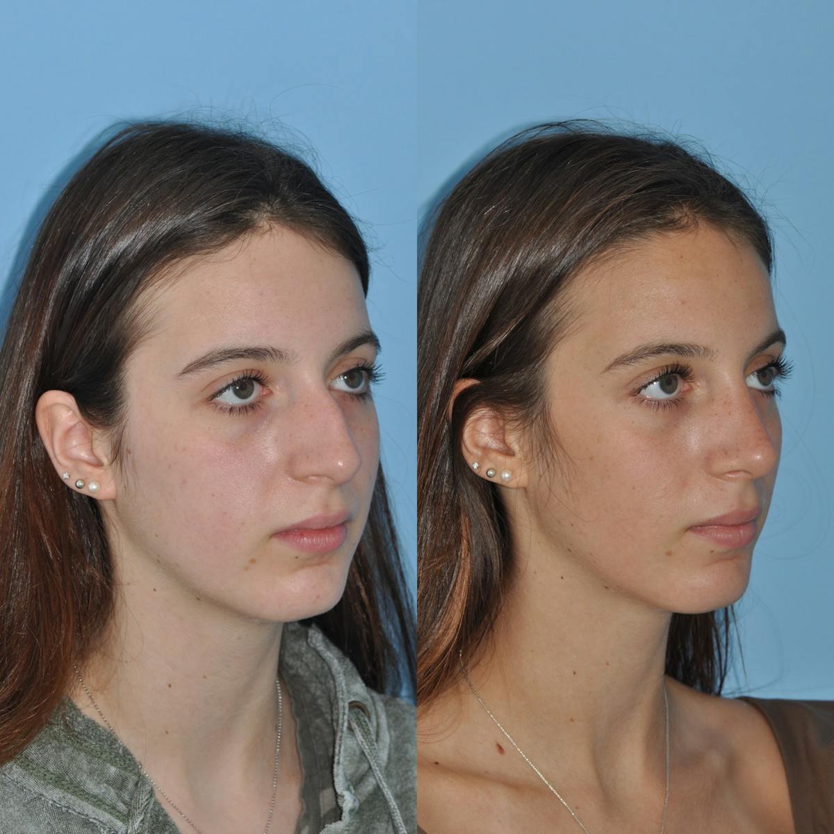 Rhinoplasty Before & After Gallery - Patient 219974 - Image 5