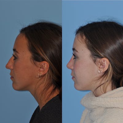 Rhinoplasty Before & After Gallery - Patient 275153 - Image 1