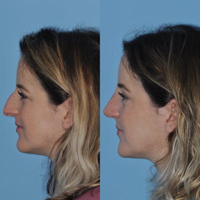 Rhinoplasty Before & After Gallery - Patient 399178 - Image 1