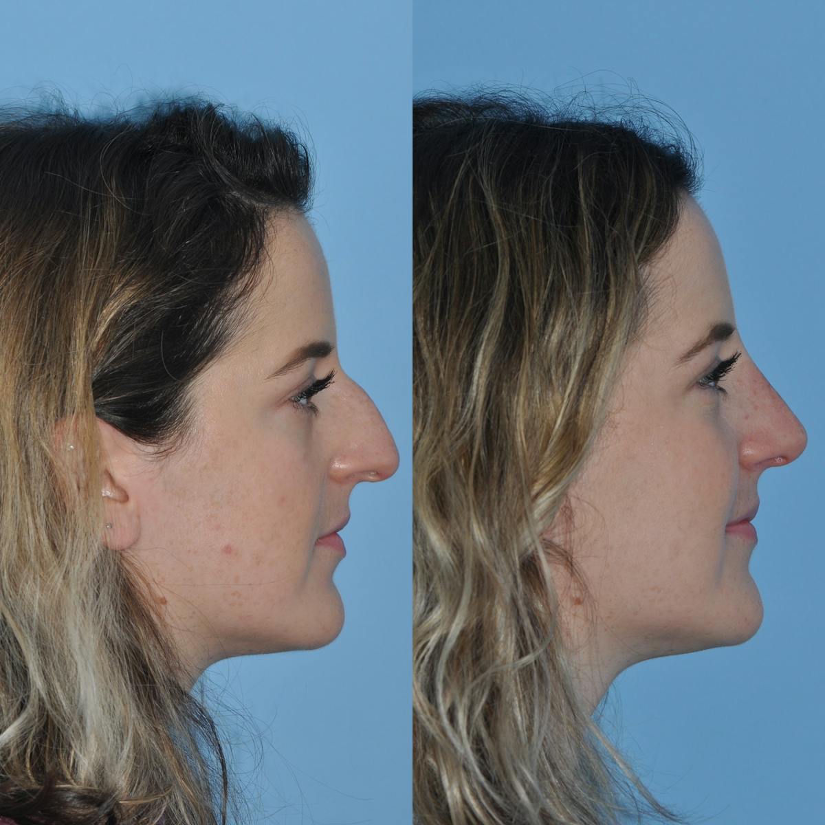 Rhinoplasty Before & After Gallery - Patient 399178 - Image 5