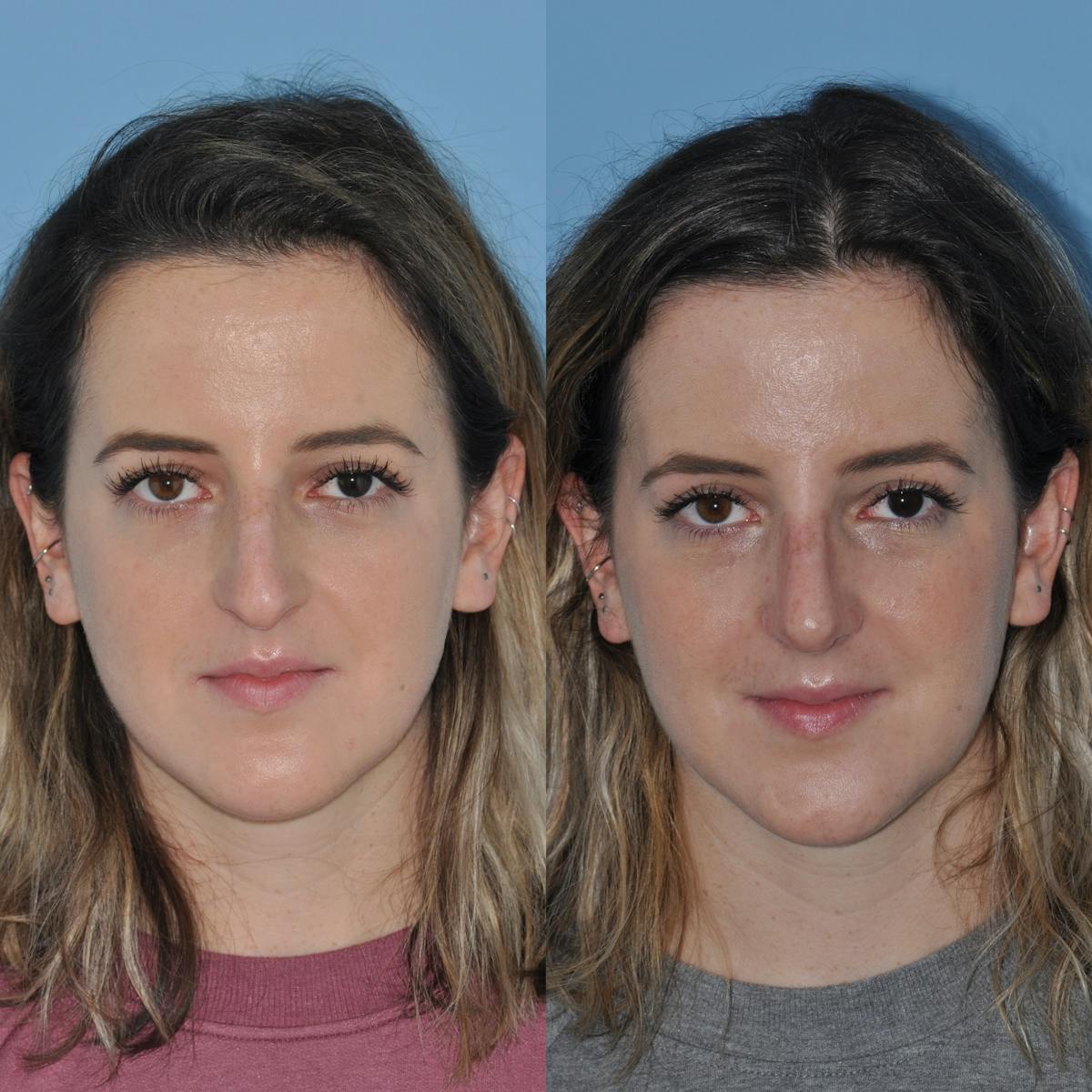 Rhinoplasty Before & After Gallery - Patient 399178 - Image 7