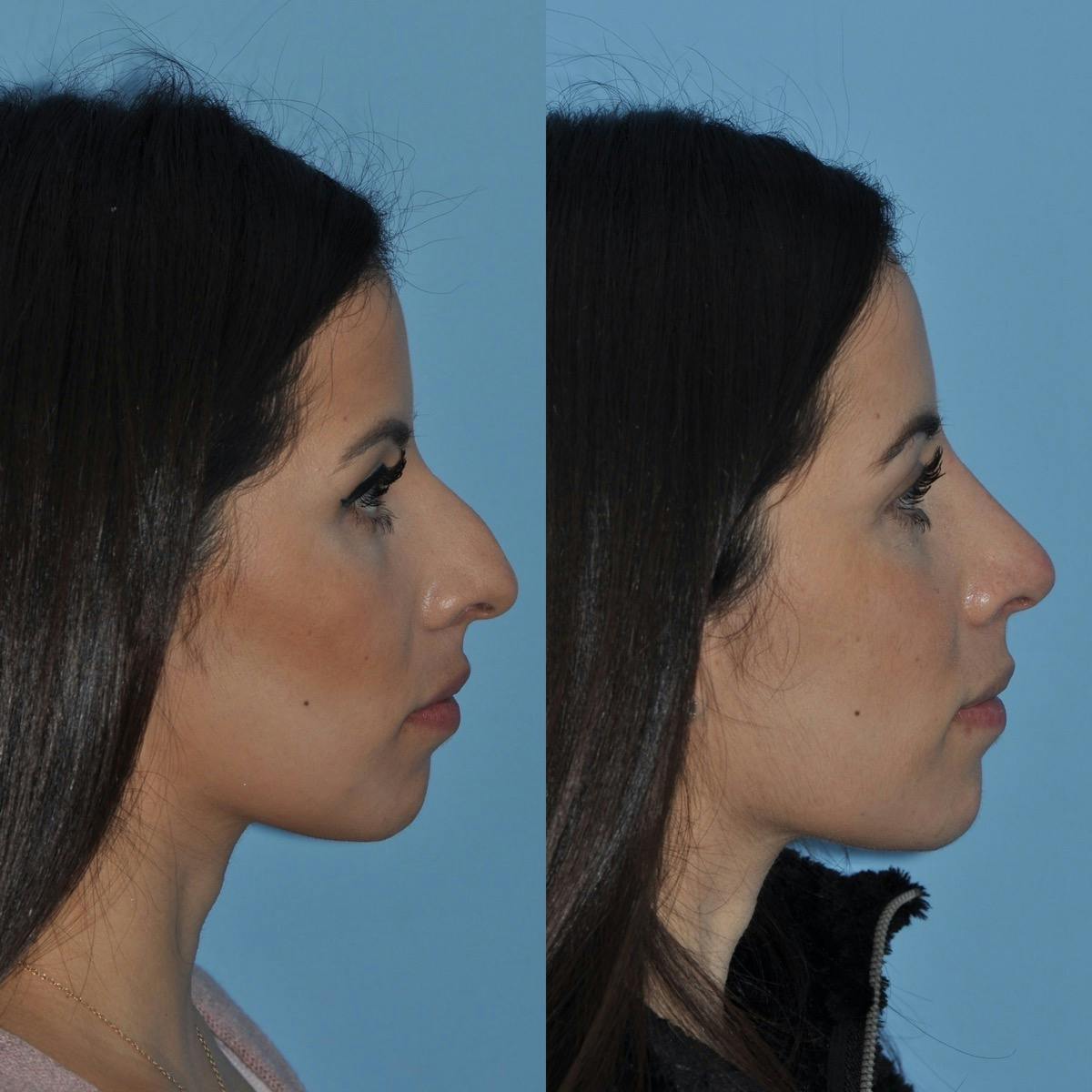 Rhinoplasty Before & After Gallery - Patient 179428 - Image 2