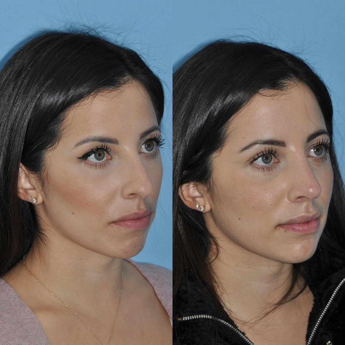 Rhinoplasty Before & After Gallery - Patient 179428 - Image 3