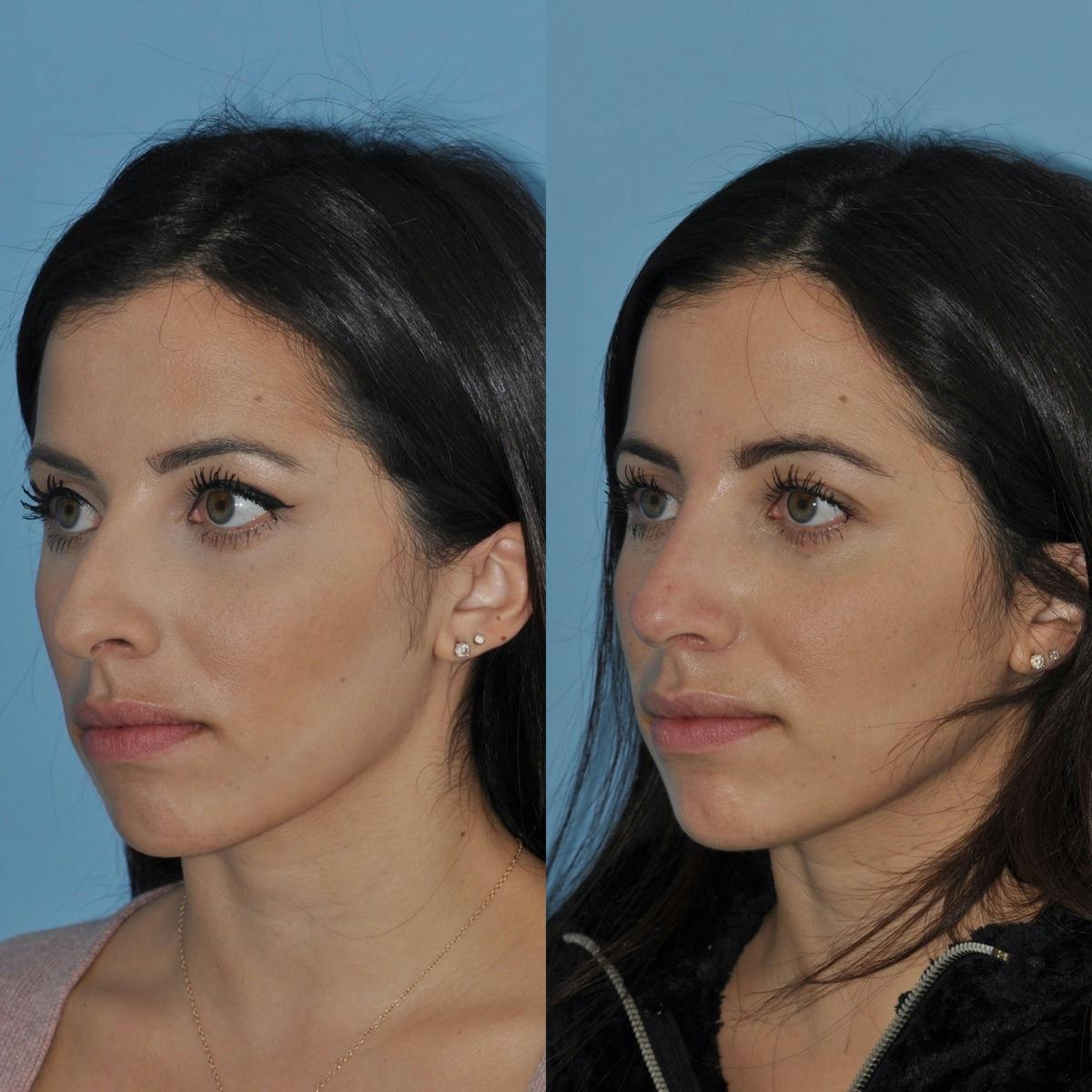 Rhinoplasty Before & After Gallery - Patient 179428 - Image 4