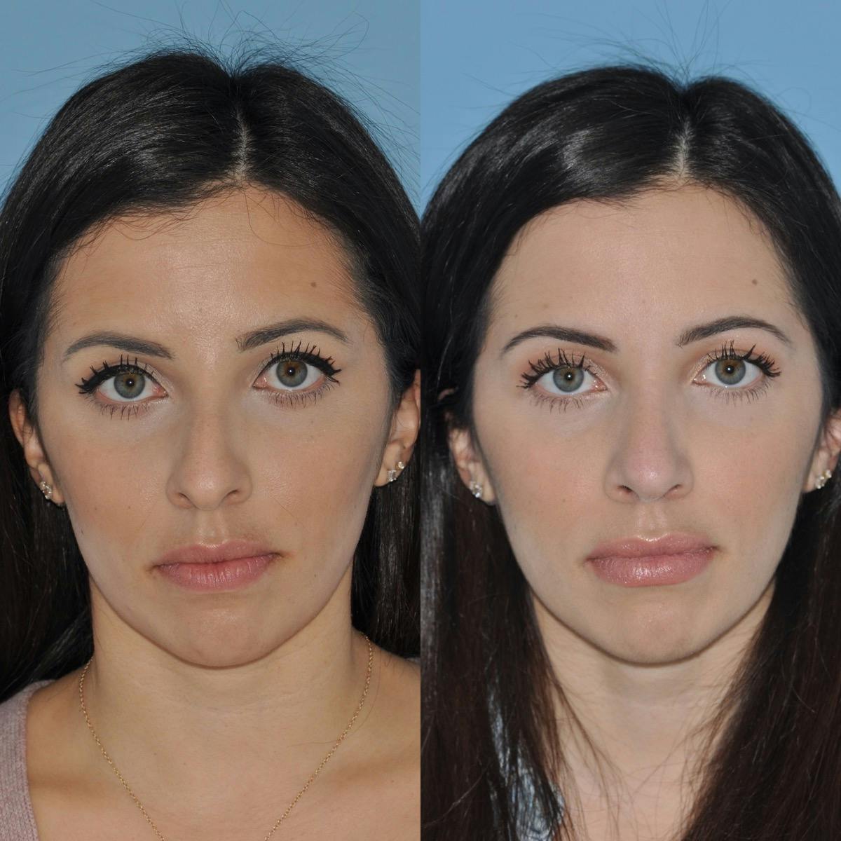 Rhinoplasty Before & After Gallery - Patient 179428 - Image 5