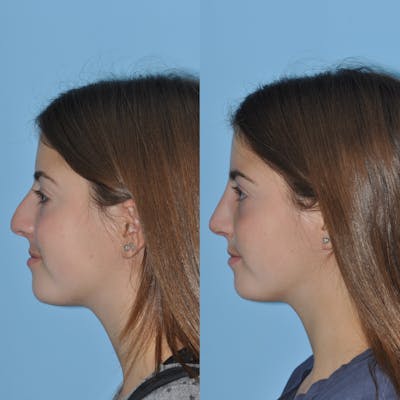 Rhinoplasty Before & After Gallery - Patient 414599 - Image 1