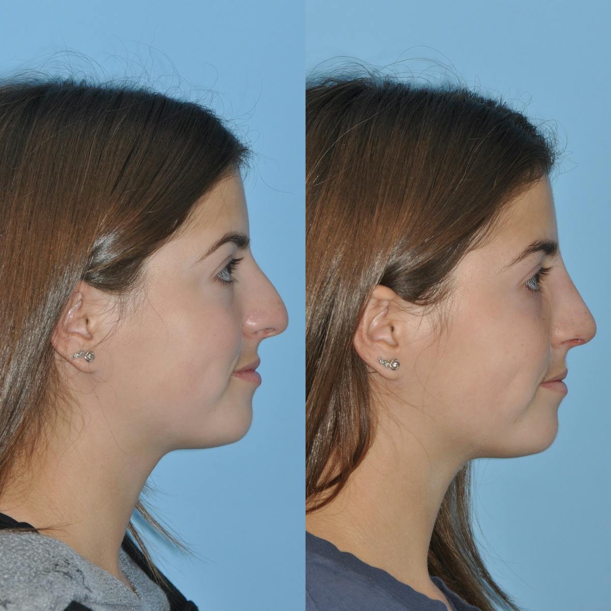 Rhinoplasty Before & After Gallery - Patient 414599 - Image 5
